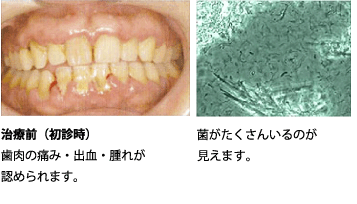 歯周病菌検査（顕微鏡）